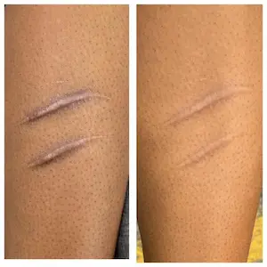 SCAR CAMOUFLAGE — Rathnam Tattoos Studio